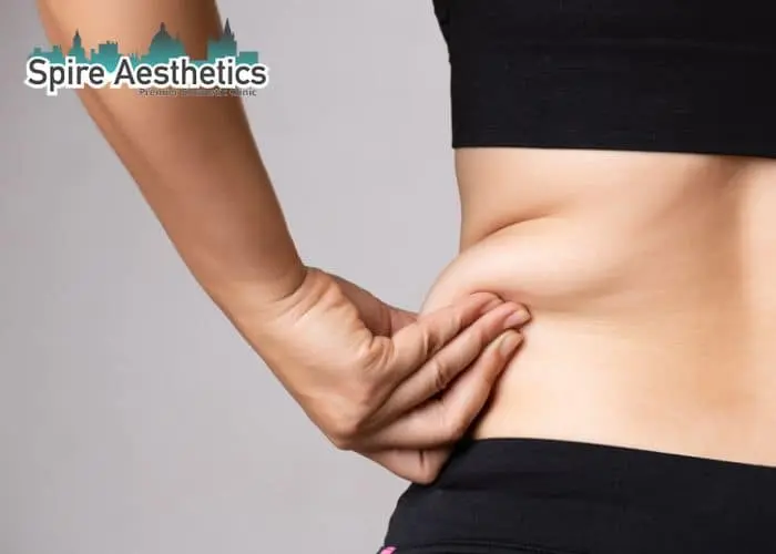 Image of woman pinching fat on their hips Eton. Fat Freezing treatment