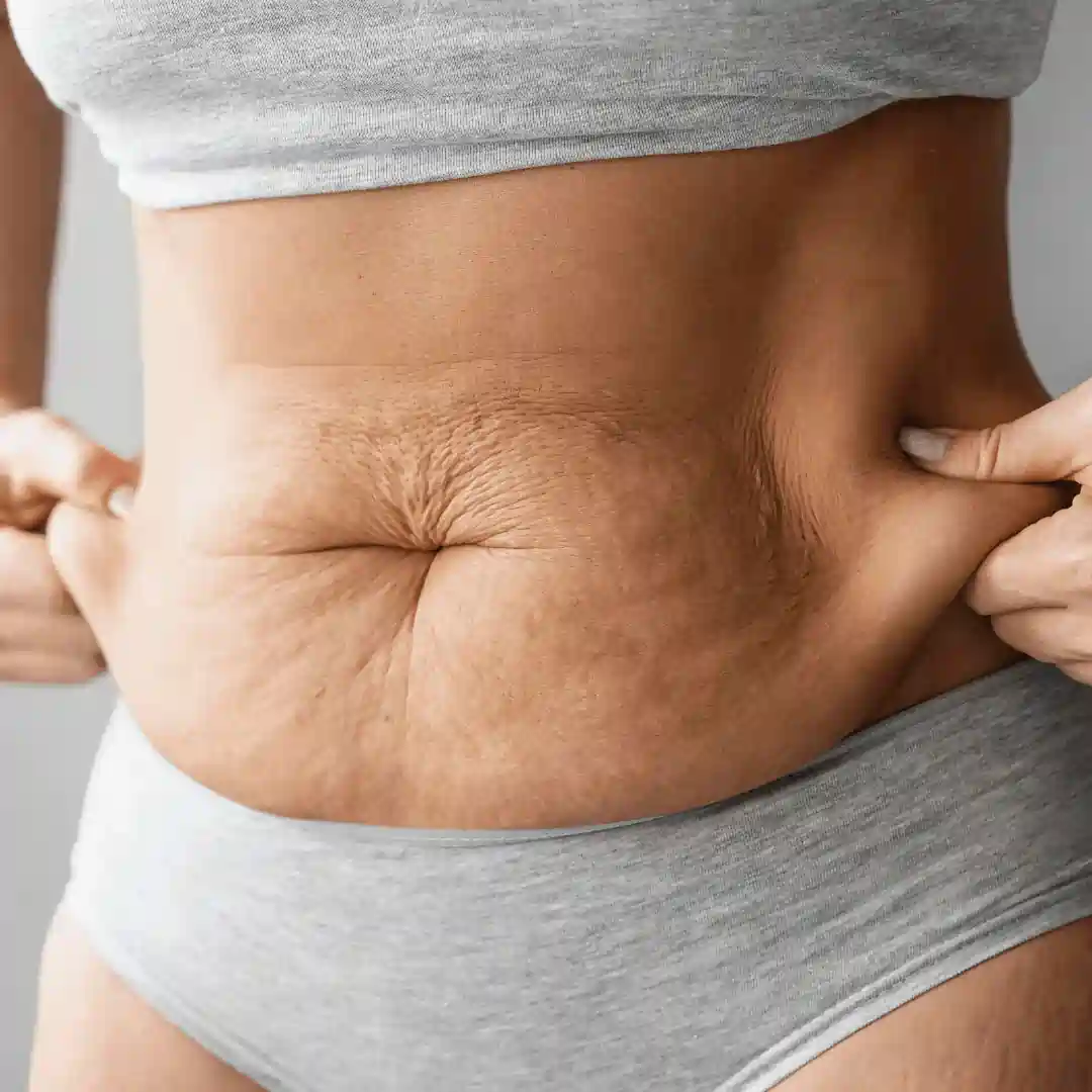 Is It Normal to Have Loose Skin After Pregnancy Eton?