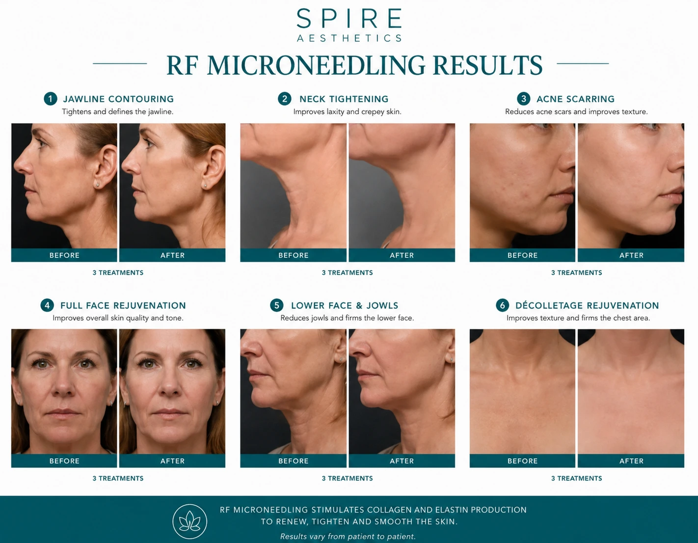 RF Microneedling Skin tightening Eton results