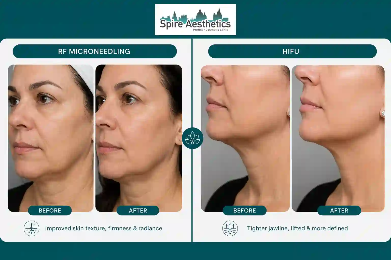 Can RF Microneedling and HIFU Be Combined Eton?
