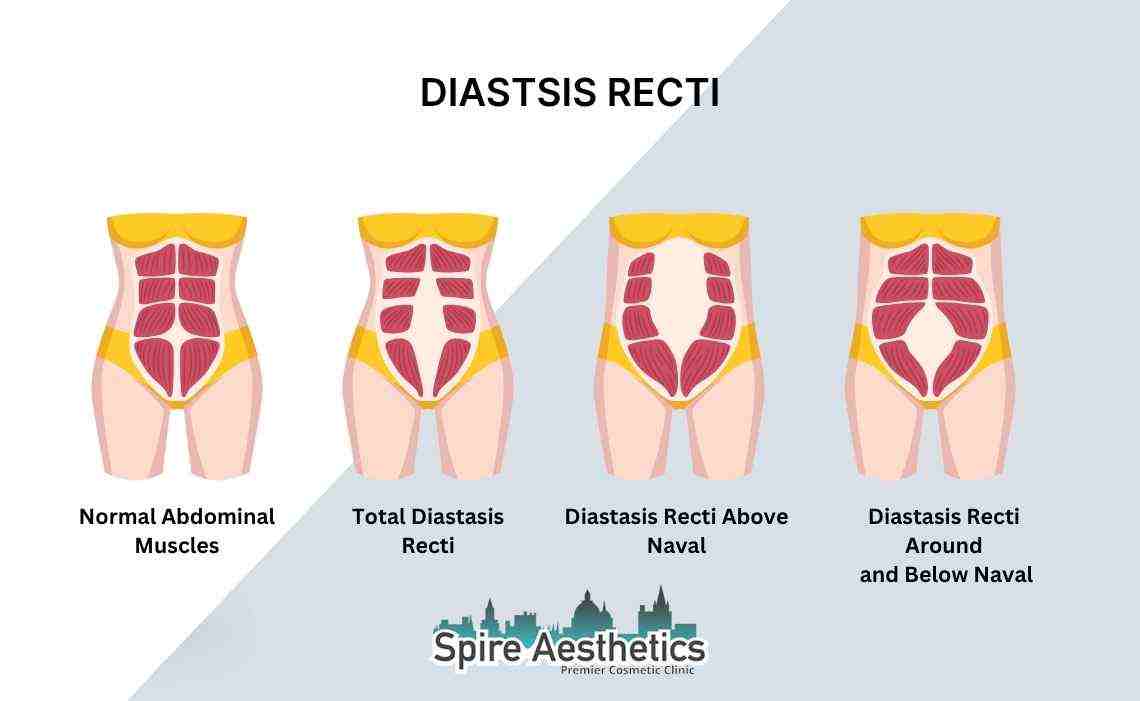 Is Non-Surgical Diastasis Recti Treatment Right for You? Common Concerns Answered Eton